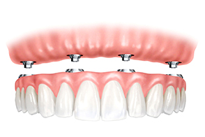 All on 4 на аттачментах